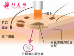 美莱王溪涛做激光祛斑如何？