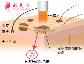 美莱王溪涛做激光祛斑如何