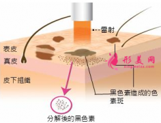 激光祛斑多少天可以洗脸？