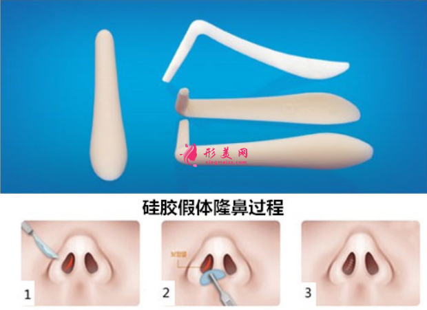 假体隆鼻会有副作用吗