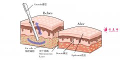 面部抽脂跟激光溶脂哪个效果好？