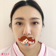 北京彤美医疗美容医院歪鼻修复案例，歪鼻洗碗妹到精致美女的逆袭