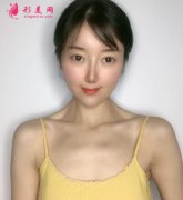 上海华美医疗美容整形假体隆胸术后两个月恢复日记