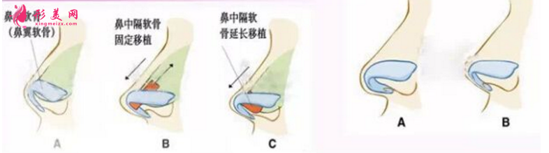 自体软骨隆鼻尖价格