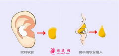 自体软骨隆鼻尖价格是多少？术后注意事项~