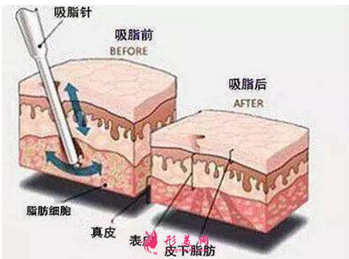 减肥吸脂术对身体的伤害