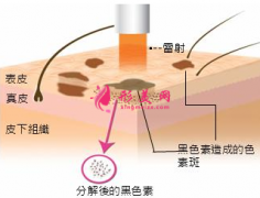 激光祛斑需要做多少次才有效果？