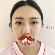 北京煤炭总医院整形歪鼻修复案例，歪鼻洗碗妹到精致美女的逆袭