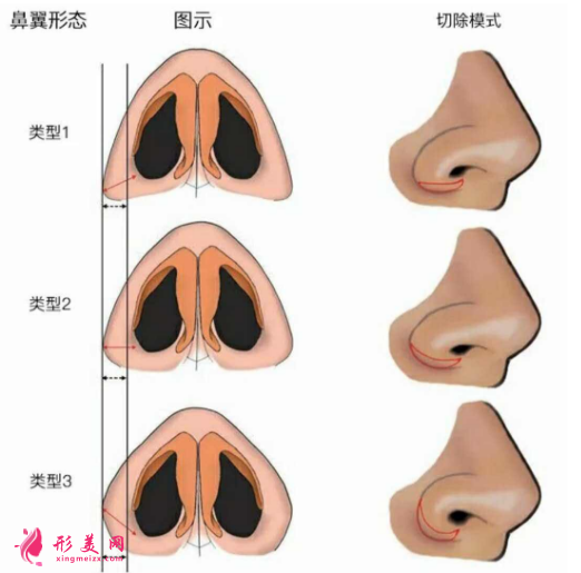 鼻翼缩小整形术