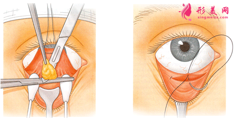 手术祛眼袋是怎么做的