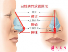 肋软骨隆鼻效果能管多久？