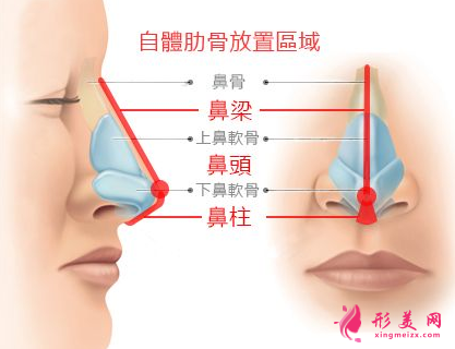 肋软骨隆鼻效果能管多久