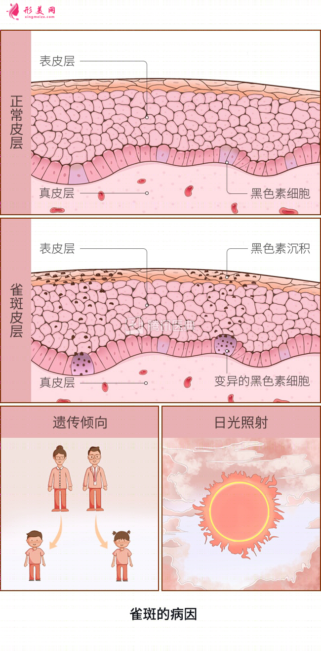 脸上的雀斑要怎么去掉