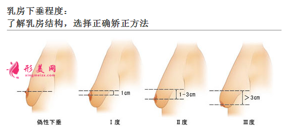 胸部下垂矫正手术多少钱