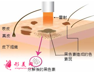 激光祛黄褐斑还会再长吗