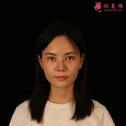 女人无需倾国倾城的整形术后图片