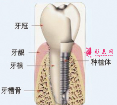 种植牙可以使用多久