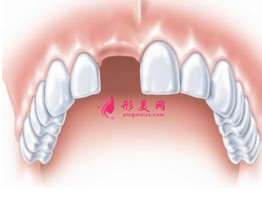 牙齿有缺失要怎么办