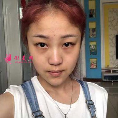 西安美莱整形美容医院隆鼻手术的案例