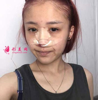 西安美莱整形美容医院隆鼻手术的案例