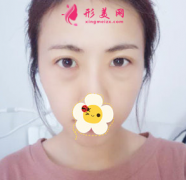 长沙丽都整形医院激光去眼袋对比图 大妈变美女 年轻好几岁