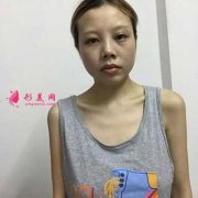 去北京丽都医疗美容医院做自体脂肪隆胸,术后180天恢复效果分享