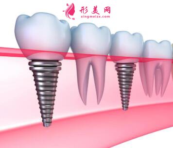 种植牙后要注意什么事项
