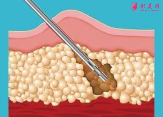 腰腹部吸脂后要按摩吗