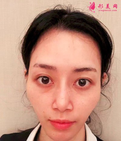 苏州美贝尔整形美容医院自体脂肪面部填充案例