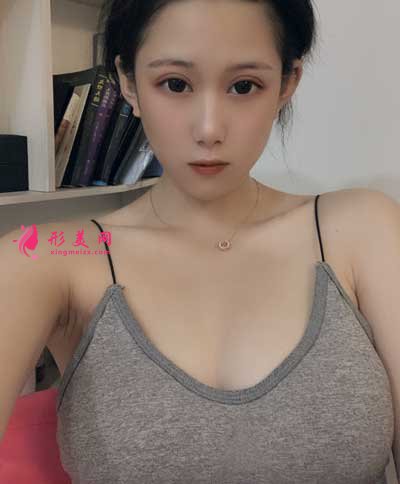 成都美莱医院吴江山为我做的假体隆胸手术后20天