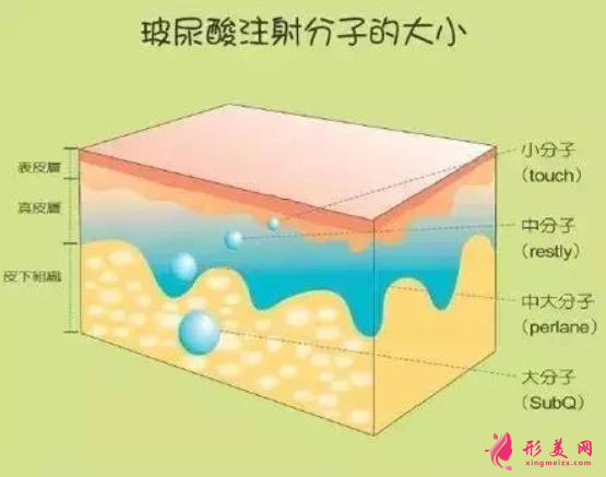 玻尿酸填充脸部效果保持多久