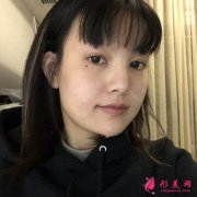 成都武侯蓉美和谐小姐姐吸脂瘦脸术后恢复情况反馈