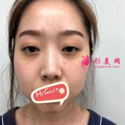 在济南瑞丽医疗美容医院做假体隆鼻后悄悄变美 太自然了吧