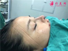 深圳鹏程医院自体肋软骨隆鼻术后恢复情况对比