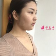 哈尔滨斯美诺医疗美容假体隆胸术后恢复情况对比