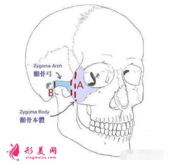 颧骨宽大：做一个颧弓内推术治标又治本！