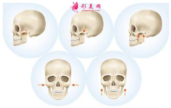 磨骨手术有7个步骤