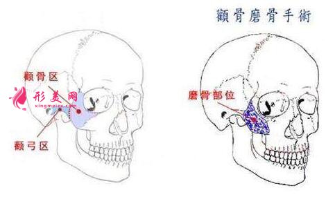 磨颧骨