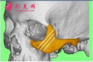 颧弓骨整形手术前的注意事项