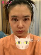 上海伯思立医疗美容全切双眼皮术后恢复情况对比