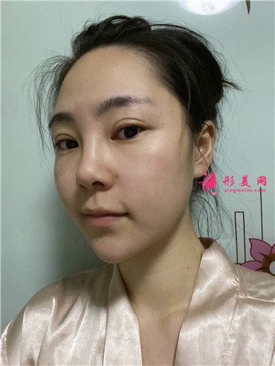 重庆小姐姐膨体隆鼻术后恢复情况对比