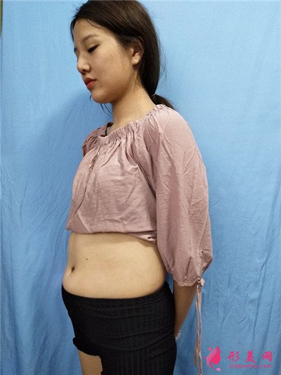 北京腰腹吸脂手术术后恢复案例分享