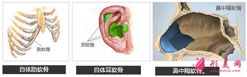 自体软骨隆鼻后有没有后遗症