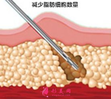 吸脂减肥哪里做得好一些