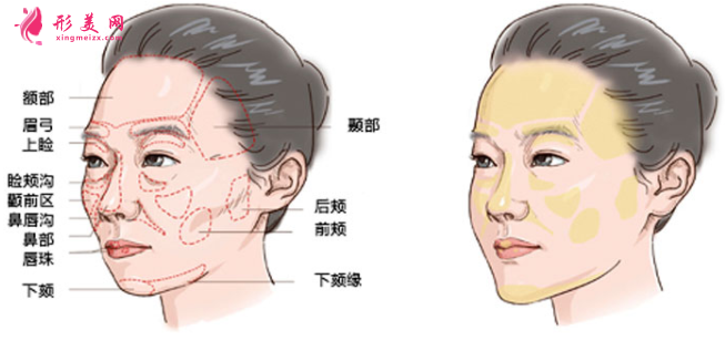 自体脂肪填充脸部要怎么做护理工作