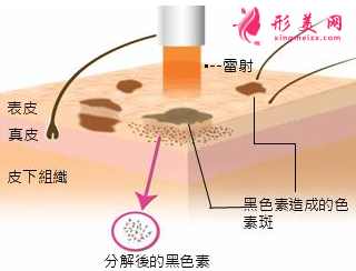 激光祛斑术后怎么做护理