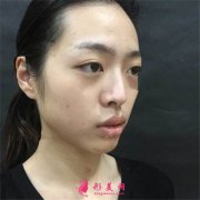 南京华美美容医院膨体隆鼻术后恢复效果分享