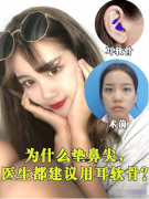 南京美贝尔整形医院的黄名斗医生隆鼻案例，做出的鼻尖真的太美了