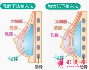 假体隆胸可以哺乳么