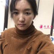 杭州华山连天美热玛吉术后恢复情况对比